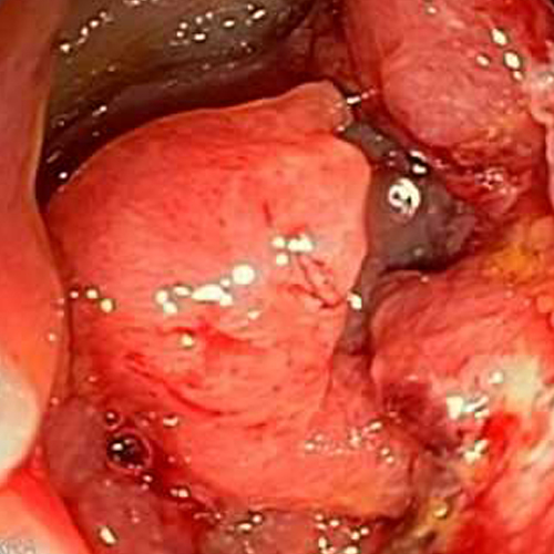 colonic polyp image