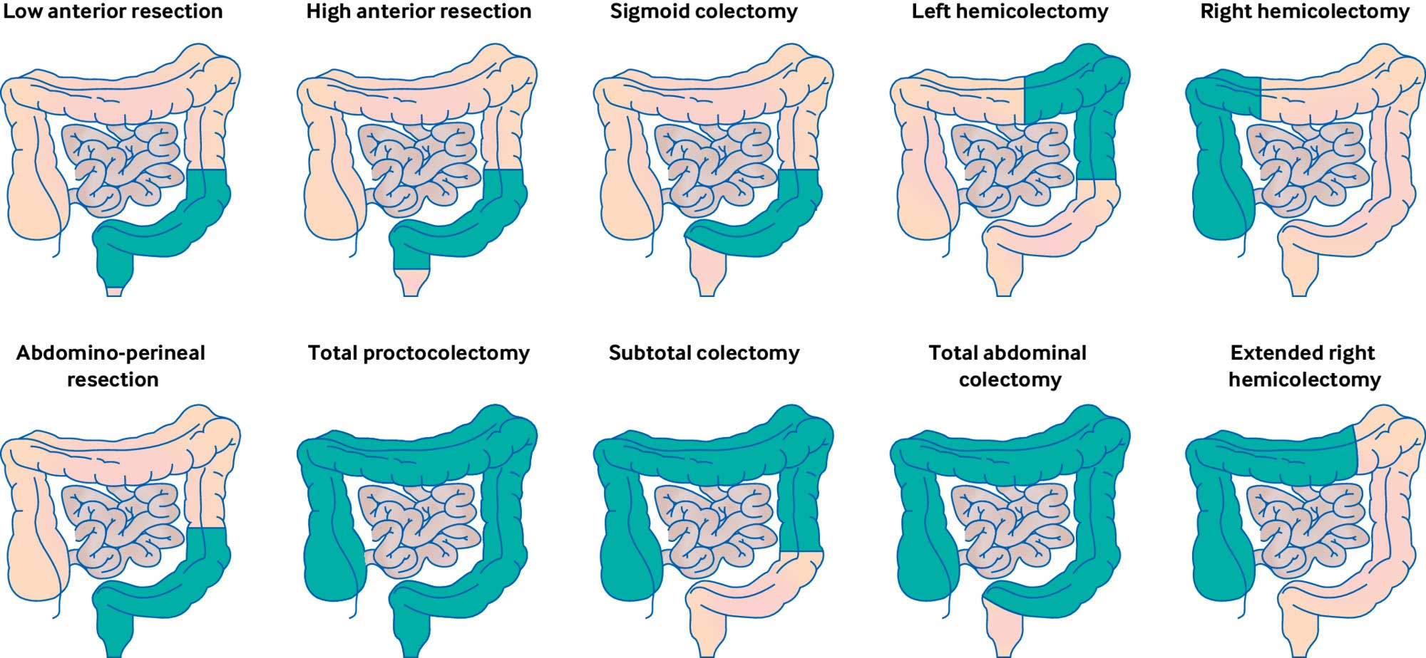 types of surgeries in colorectal cancer