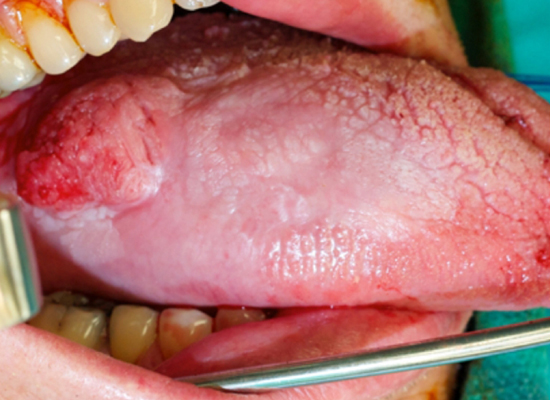 tongue cancer lesion