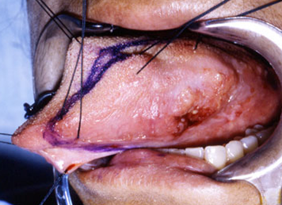 tongue cancer surgery
