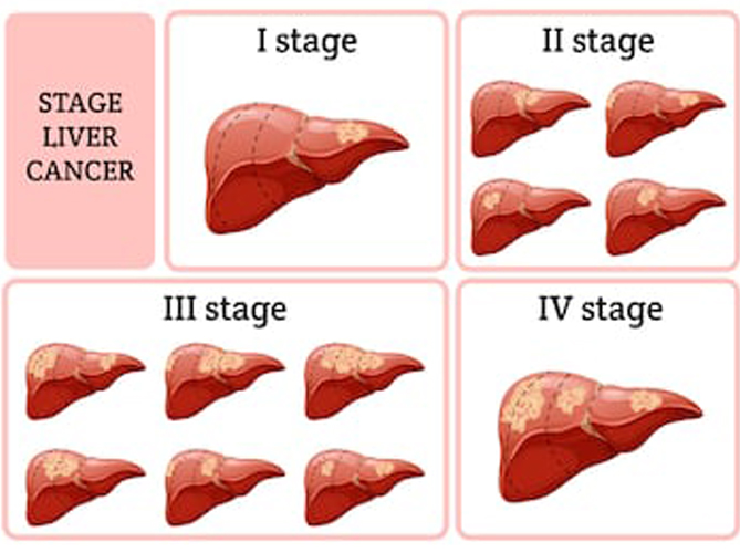 stages of liver cancer