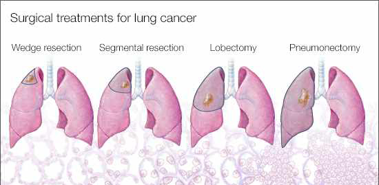 surgeries for lung cancer