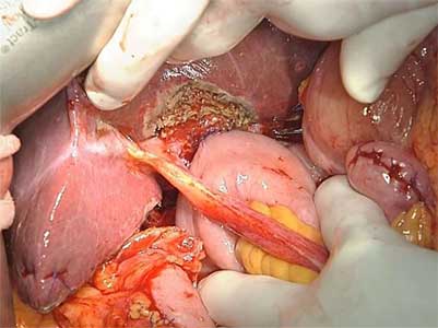 surgery for pancreatic cancer