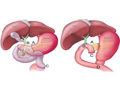 whipples surgery - pancreatico-duodenectomy