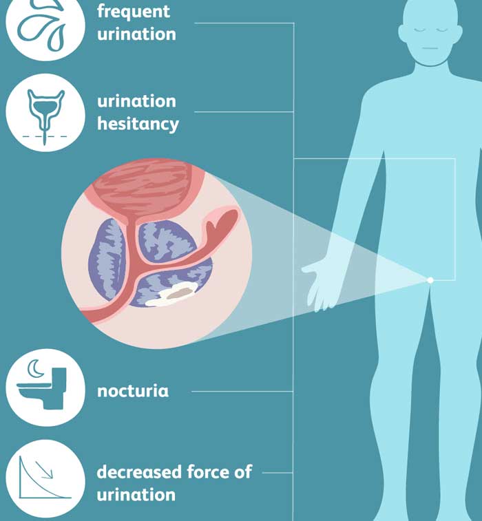 symptoms of prostate cancer