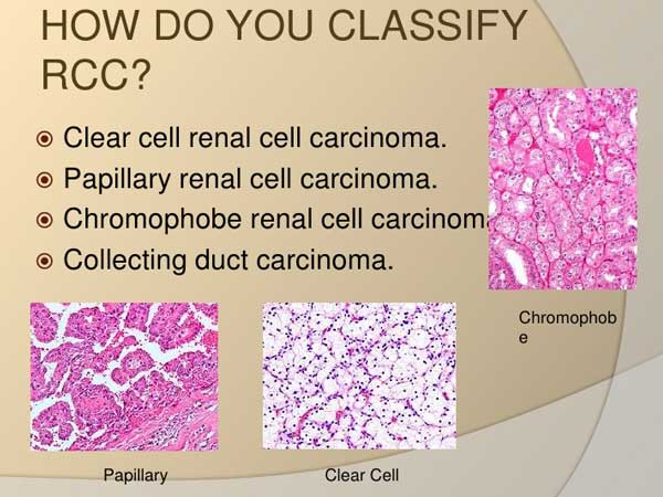 classification of renal cell cancer