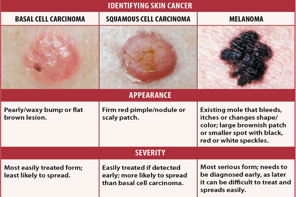 identify different types of skin cancers