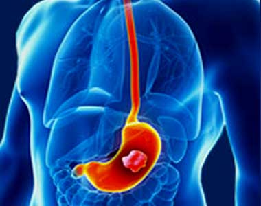 Stomach & Small Intestinal Cancer