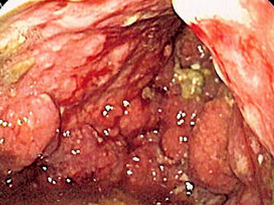 endoscopic view of gastric ulcer