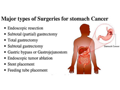 types of surgeries in gastric cancer