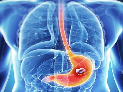 gastric cancer image