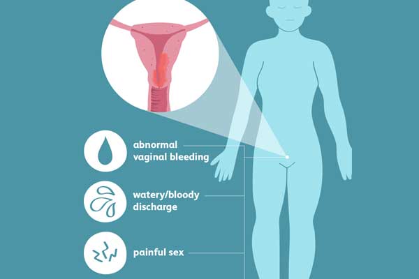 signs of endometrial cancer